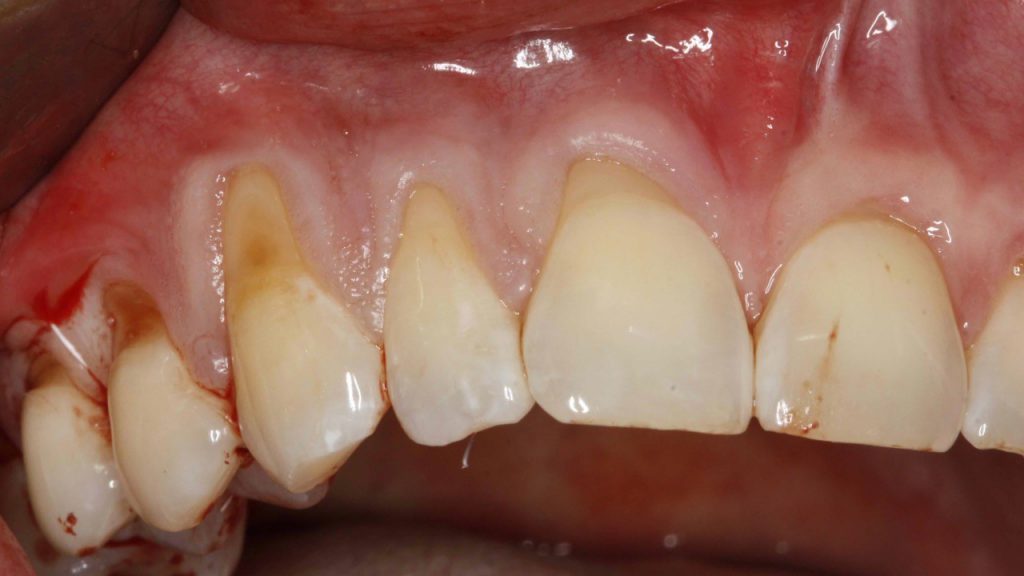 Nieleczone zęby niszczą cały organizm