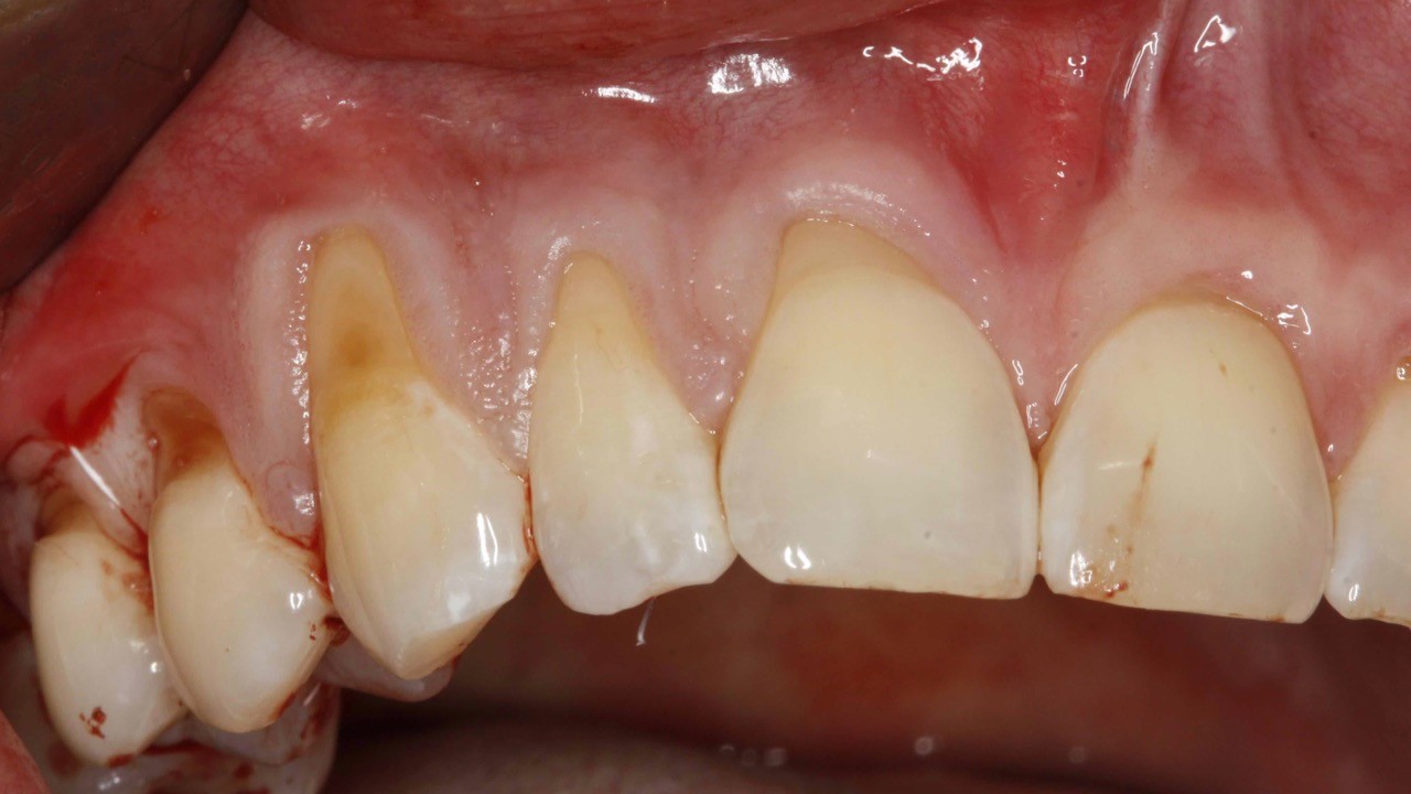 Nieleczone zęby niszczą cały organizm