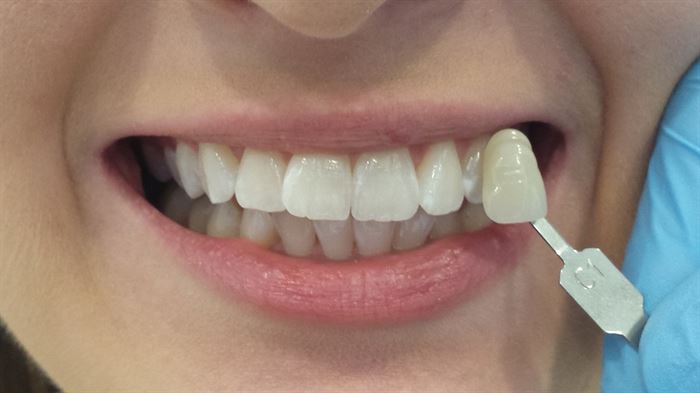 uzupełnienia stałe